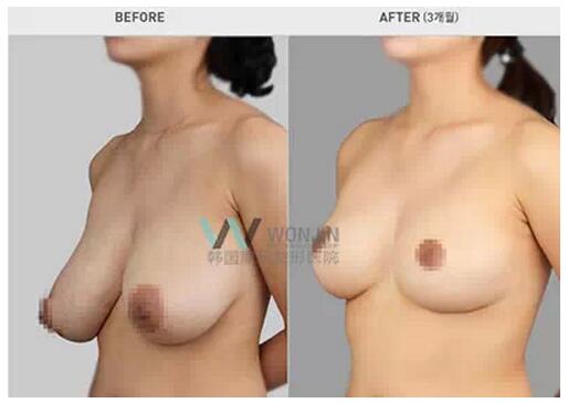 乳房整形手术